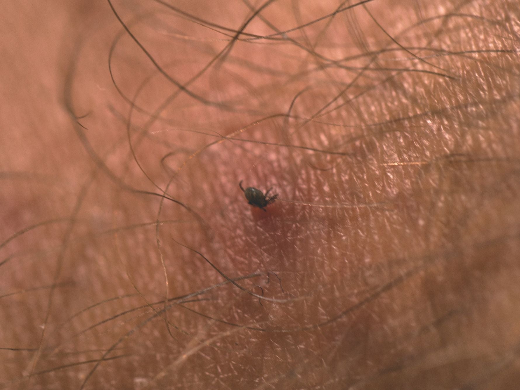 Picture of tick on skin